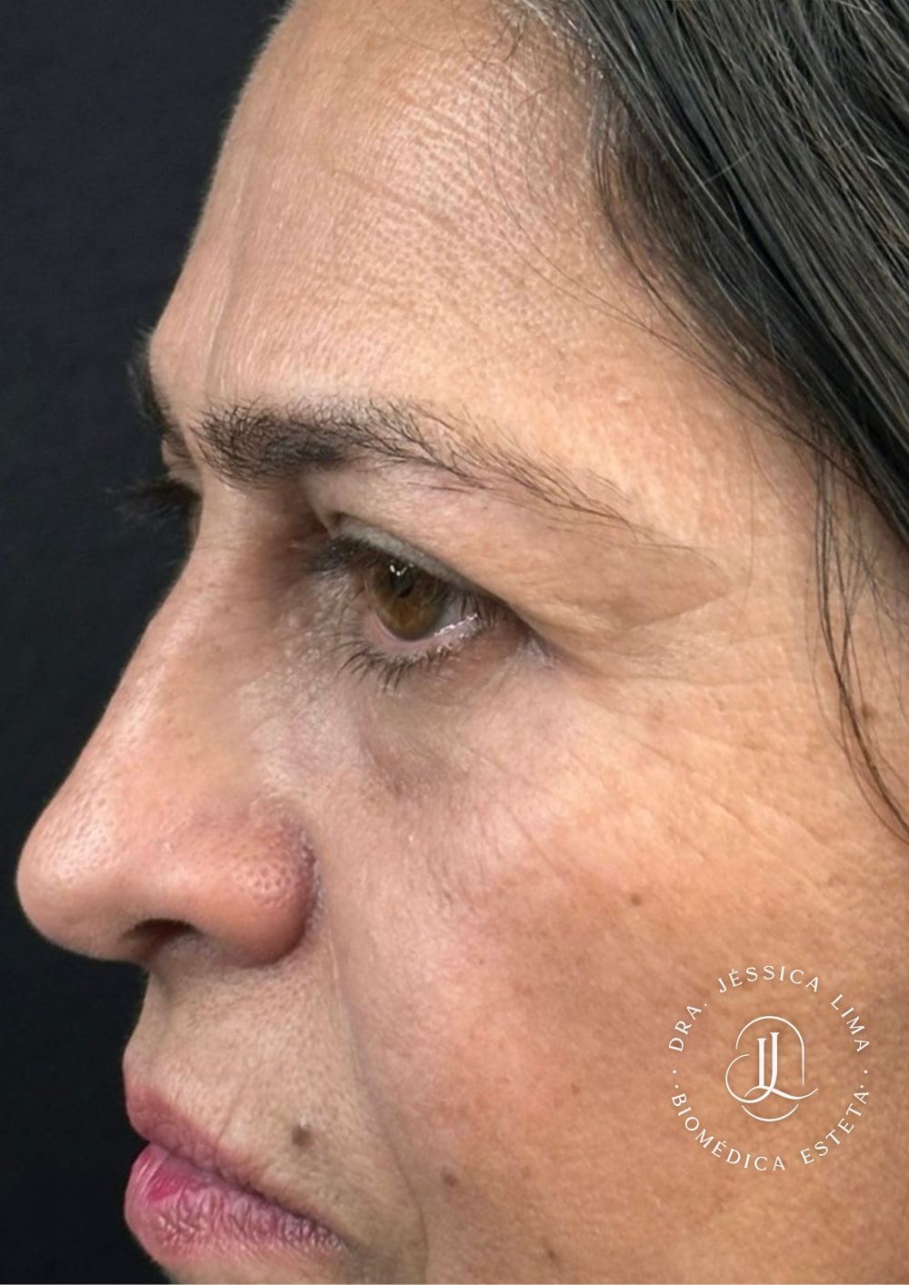 Pele da região dos olhos, de perfil antes, gerenciamento de pele