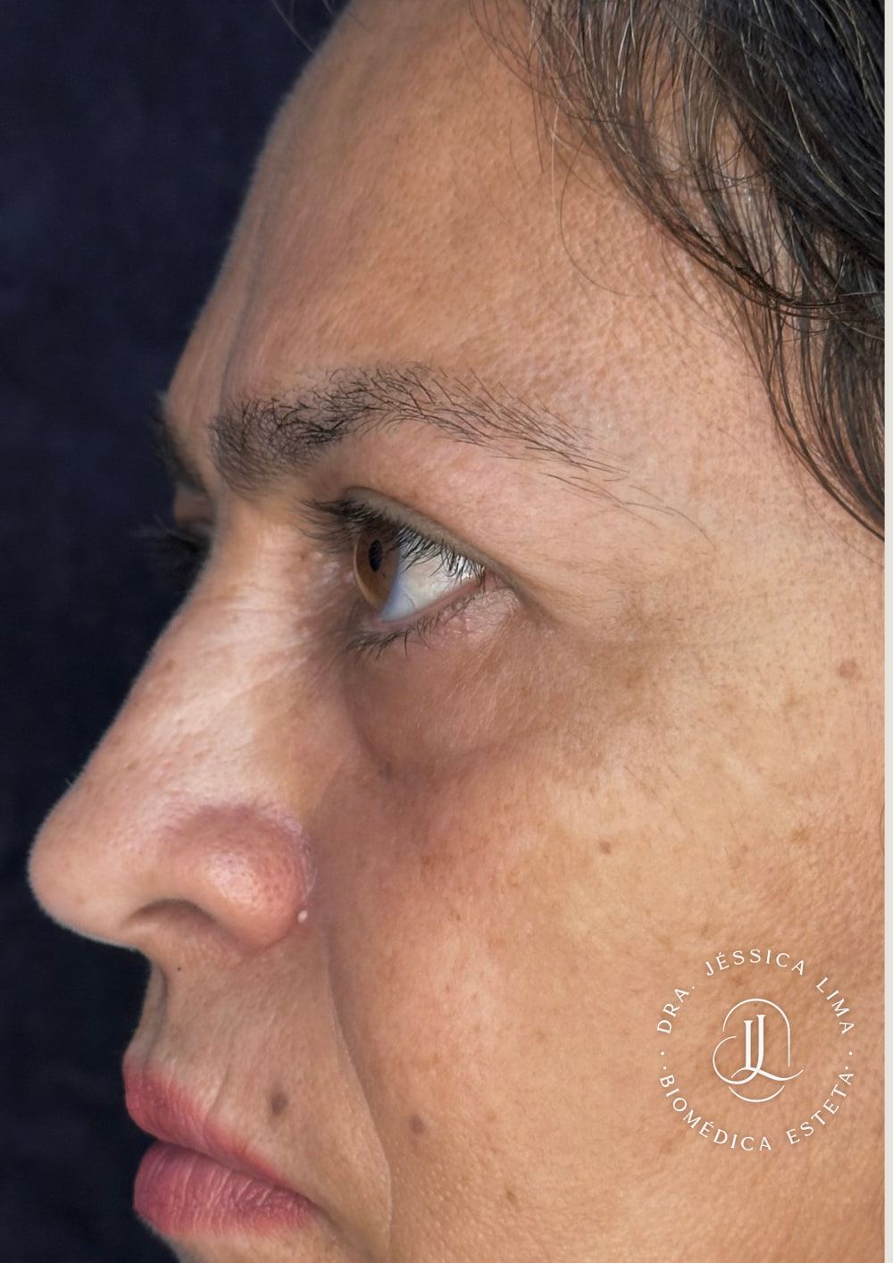 Pele da região dos olhos, de perfil depois, gerenciamento de pele