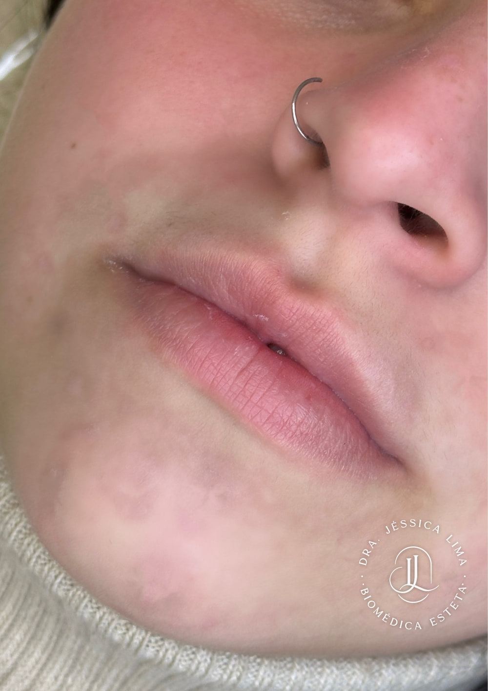 Lábios antes, preenchimento labial