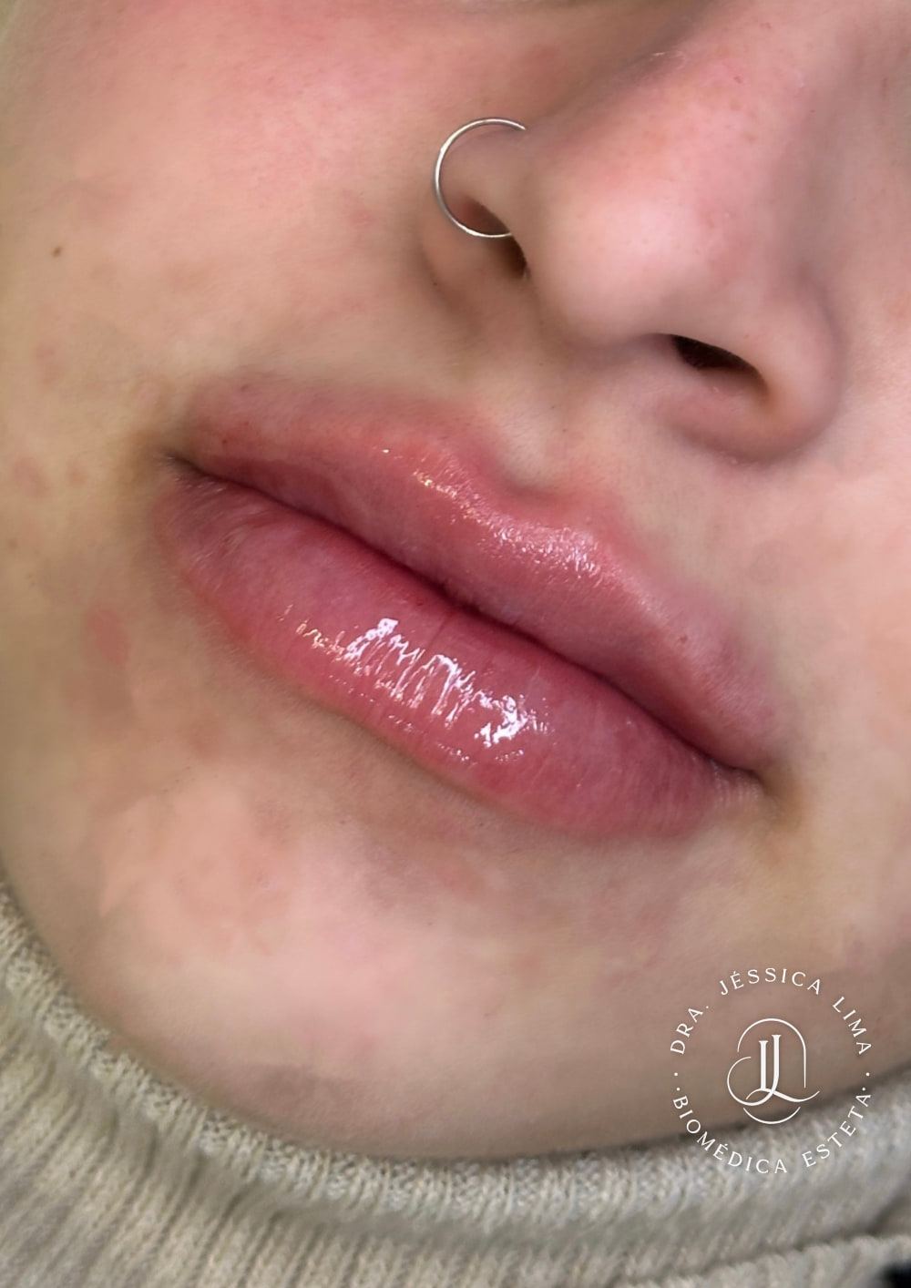 Lábios depois, preenchimento labial