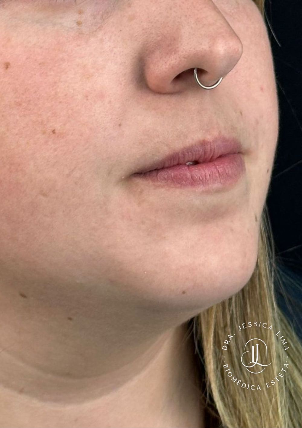 Lábios antes, preenchimento labial