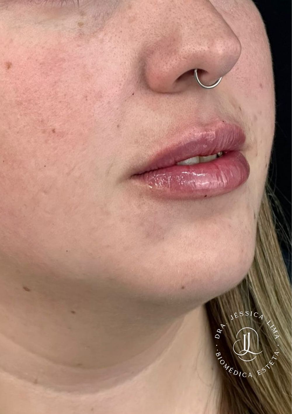 Lábios depois, preenchimento labial