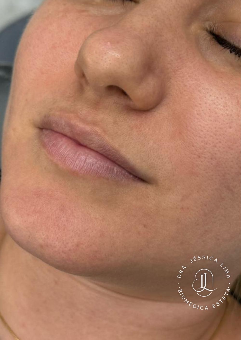 Lábios antes, preenchimento labial