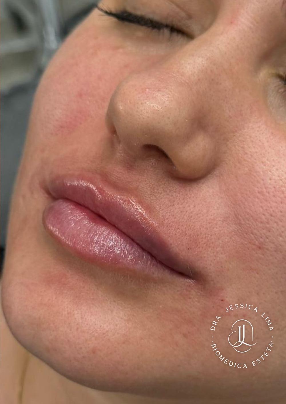 Lábios depois, preenchimento labial