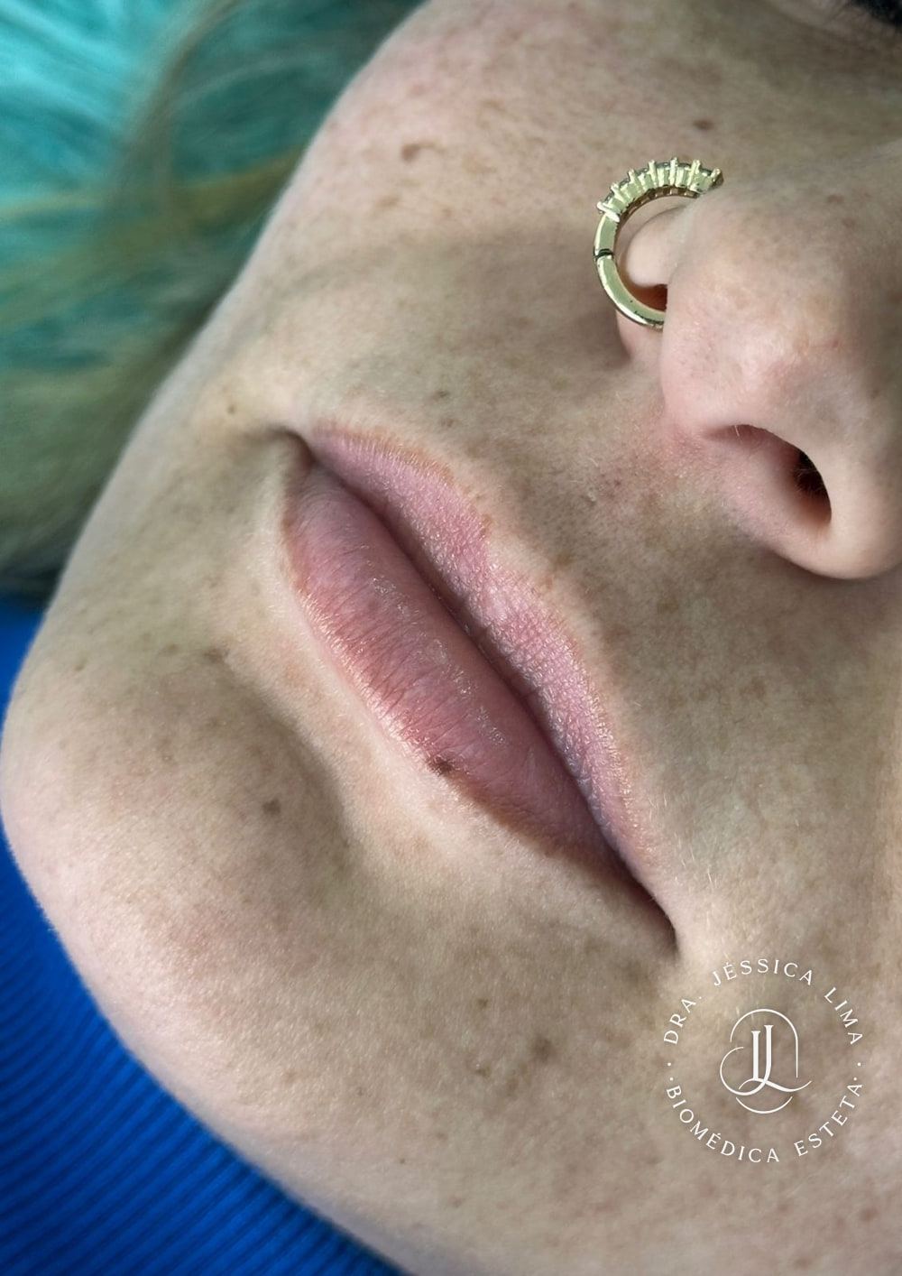 Lábios antes, preenchimento labial