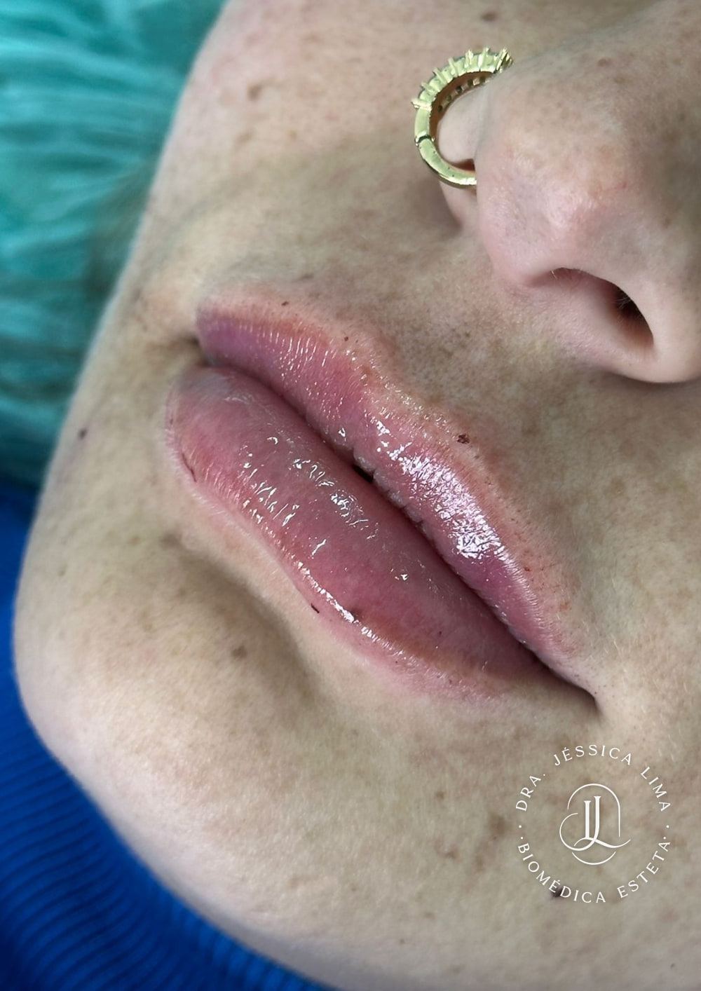 Lábios depois, preenchimento labial