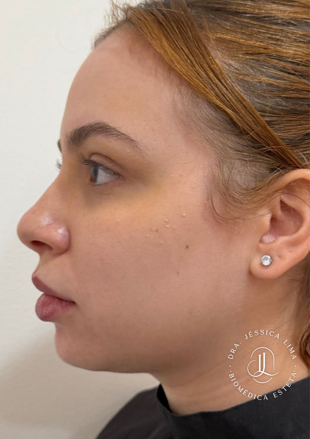 Perfil do rosto antes, preenchimento de queixo e mandíbula