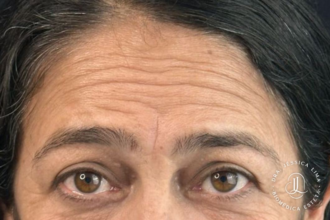 Testa e olhos antes, toxina botulínica na testa