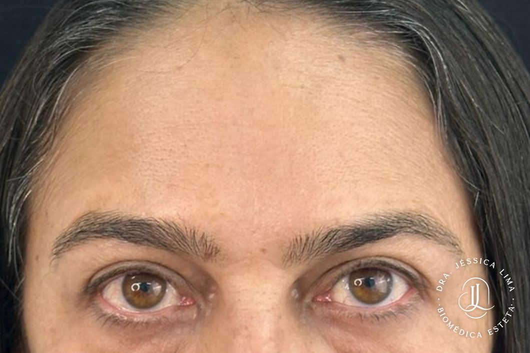 Testa e olhos depois, toxina botulínica na testa