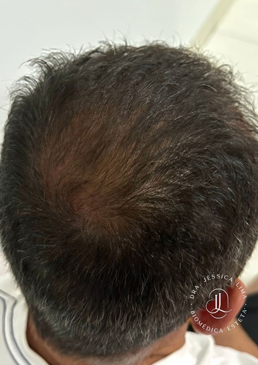 Topo da cabeça depois, tratamento capilar